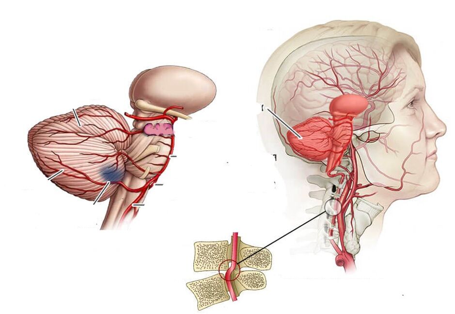 Cerebelláris ischaemia